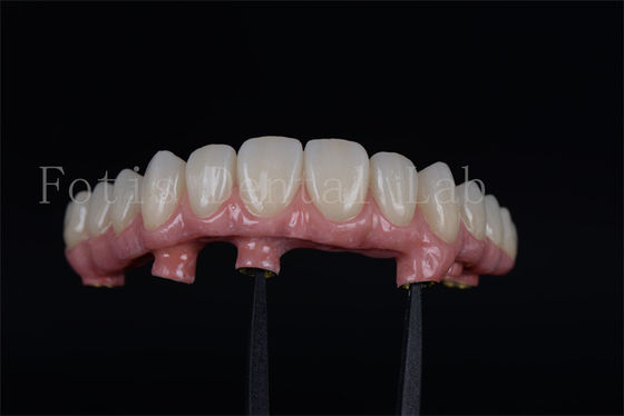 Volledig kauwvermogen herstellen met 4 of 6 implantaten