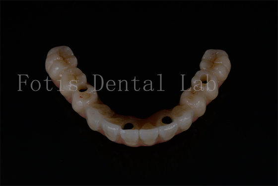 Vervanging van alle op 4 alle op 6 geavanceerde tandheelkundige implantaten voor optimale functionaliteit