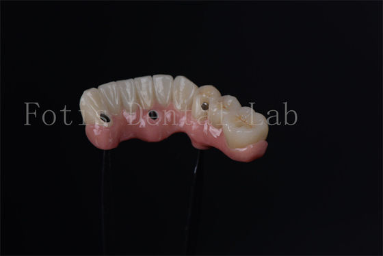 Individuele All On 4 All On 6 endosteale implantaten voor onmiddellijke tandvervanging