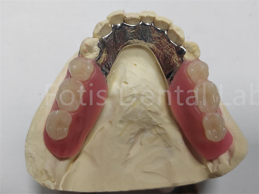 OEM Flexible Removable Partial Prothese Makkelijk te reinigen / onderhouden