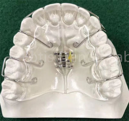 State-of-the-art orthodontische apparaat uitbreidende retainer aanpasbaar