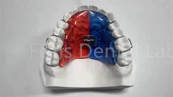 Persoonlijke orthodontische expander voor tandcorrectie en verbetering