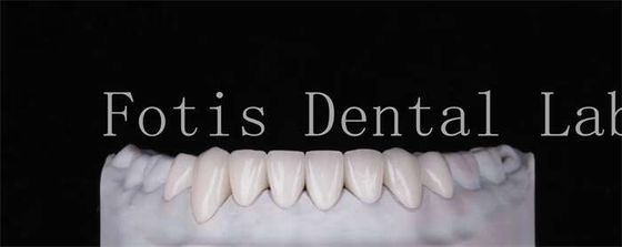 Hoge duurzaamheid Natuurlijk uitziende tanden veneers 0,3 mm-0,5 mm Dikte