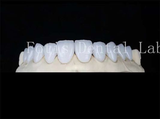 Gepersonaliseerde natuurlijke porseleinen veneers tandheelkundige lab veneers vlekbestendig