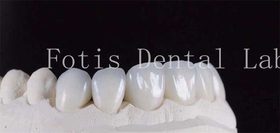 Ultra Sterk Translucent Tandheelkundig Laminaat Veneers Natuurlijke kleur