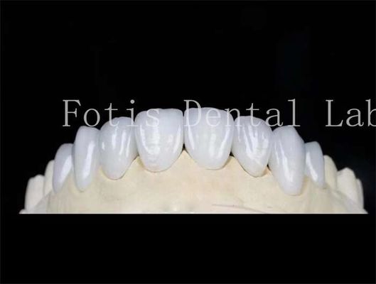Natuurlijke kleur tandheelkundige laminaat veneers valse tanden veneers met bindingscement