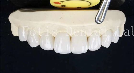 0.3-0.5mm keramische gelamineerde tanden valse tanden veneers met kleefbindingscement