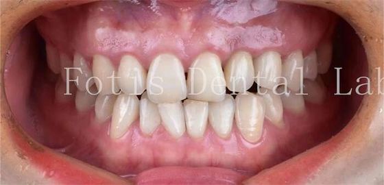 Cosmetische tandheelkunde Tandheelkundige porseleinen veneers met een hoge vlekbestendigheid