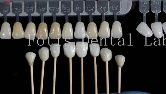 Aanpassing Natuurlijke tandheelkundige veneers Valse tanden Overlays Hoge sterkte
