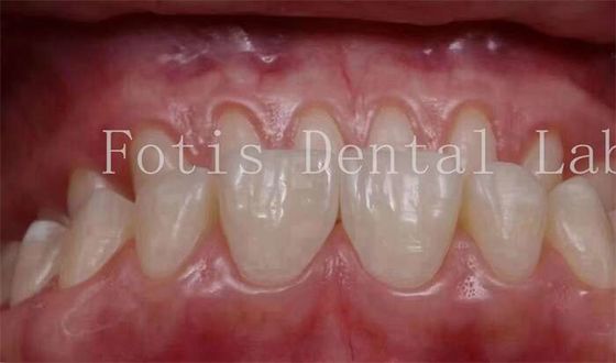 0.3-0.5mm Dikte Cosmetische tanden bedekken veneers voor cosmetische tandheelkunde