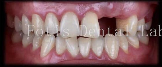 Gepersonaliseerde natuurlijke tijdelijke veneers voor een mooie glimlach