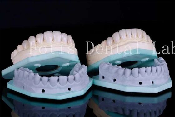 Vlekbestendige tandheelkundige veneers tandheelkundige kliniek veneers 0,3 mm-0,5 mm Dikte