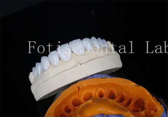 Porseleinen tandheelkundige lab veneers Bindingscement voor langdurige restauratie
