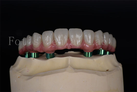 Langdurig Titanium/Zirconia All on 4/6 Implantaten Gemakkelijk onderhoud Hoog succespercentage