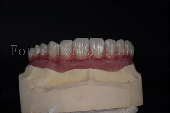 Natuurlijke esthetiek met betaalbare All on 4 All on 6 implantaten
