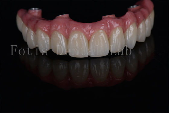 Langdurig All on 4 All on 6 tandheelkundige implantaten Minimaal invasief en eenvoudig te onderhouden voor behoeften aan lage botdichtheid
