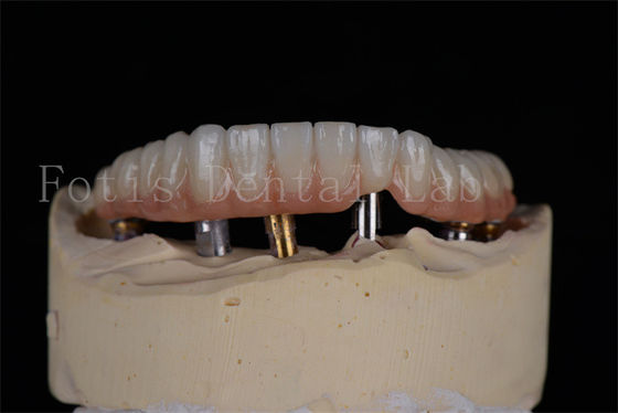 Goedkope natuurlijke uitstraling 4 of 6 implantaten volboog Succespercentage Minimaal invasieve oplossing