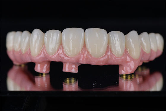 Individuele All On 4 All On 6 tandheelkundige implantaten herstellen volledig kauwvermogen