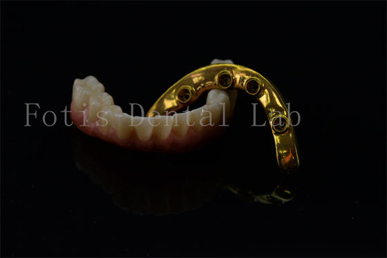 Titanium Zirconia All On 4 All On 6 Implantaten Volledige glimlach Implantaten Levenslange garantie