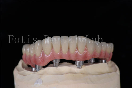 Minimaal invasief dezelfde dag alle op 4 alle op 6 implantaten natuurlijk uitzien gemakkelijk te reinigen