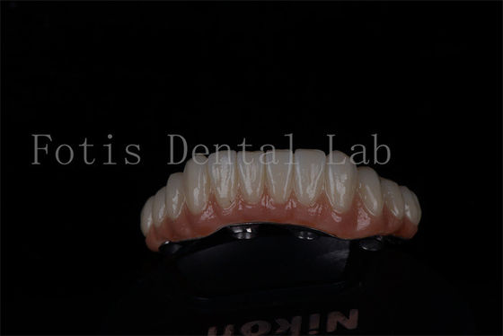 Volle mondherstel Alle op 4 en alle op 6 Titanium of Zirconia