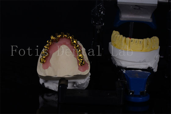 Goedkope Titanium / Zirconia All On 4 Implantaten voor een natuurlijke glimlach