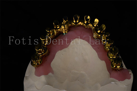 All On 4 All On 6 tandheelkundige implantaten herstellen de volledige kauwvermogen