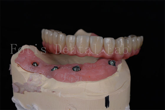 Aanpasbare All On 4 All On 6 tandheelkundige implantaten voor volledige mondrehabilitatie