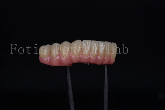 Snel en effectief alle op vier alle op zes in een dag Implantaten Veiligheid gewaarborgd