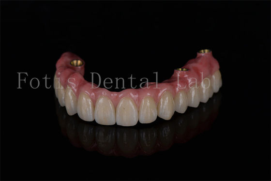Volledige boogherstel All On Four Implantaten voor optimale tandheelkundige implantaten prestaties