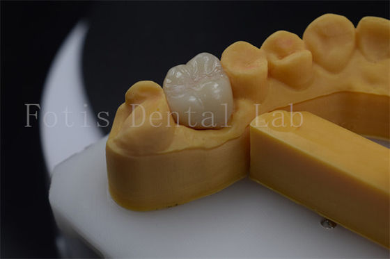 Titanium / PFM Prothese Kroon Aanpasbaar Zirconia Implantat Kroon Duurzaam