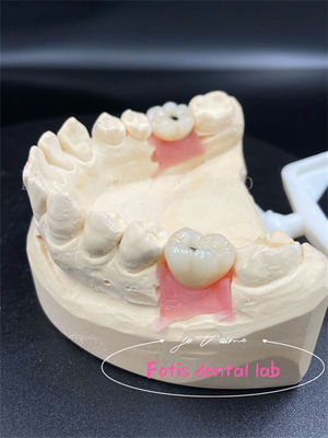 Aanpassing Titanium/Ziconia/PFM tandheelkundige lab kronen Comfortabel