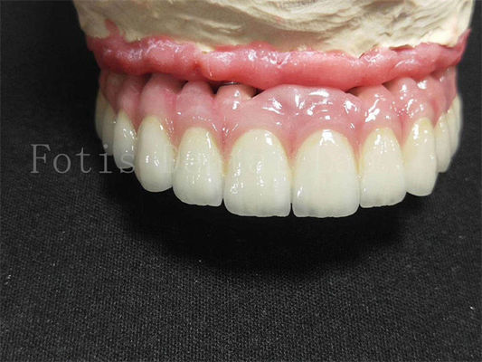 Titanium / Zirconia Implantatie Kroon Gepolijst Afwerking Kunstmatige tandkronijn