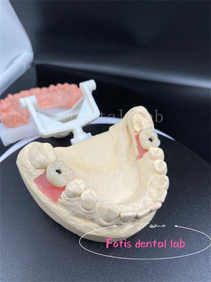Precision Fit Full Mouth tandheelkundige kronen Makkelijke plaatsing Valse tandkronen