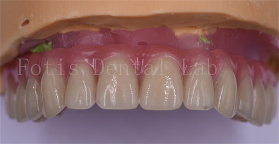 Patiëntcomfort Aanpassing van tandheelkundige kronen gepolijst titanium/zirconia/PFM-implantakroon