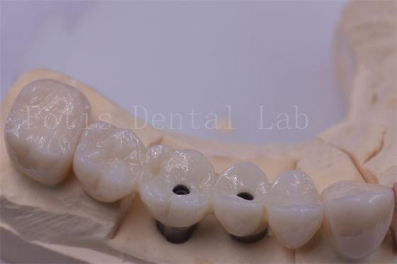 Titanium / Zirconia tandkronen Zilver gepolijst voor ontbrekende tanden