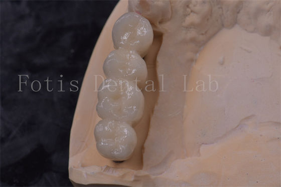 Precision Fit Zirconia Tandkrans Implantat PFM Kroon Makkelijk te reinigen
