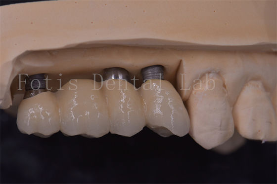 Precision fit tandheelkundige implantaten kronen Titanium / Zirconia / PFM Herstel ontbrekende tanden