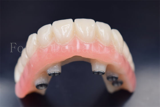 Op maat gemaakte tandheelkundige implantaten Kronen Vervanging slijtvastheid