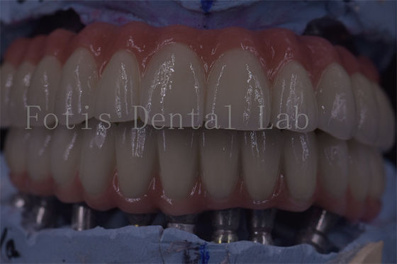 Geavanceerde tandheelkundige implantaten voor superieure functionaliteit