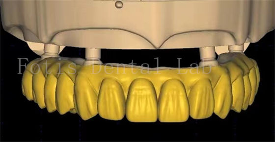OEM tandheelkundige kroonontwerp maakt gebruik van geavanceerde scanning en 3D-printing technologie