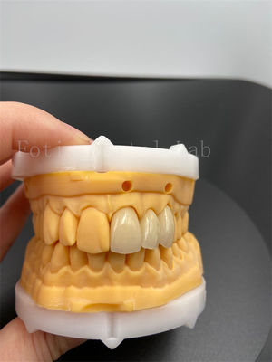 Precision Fit Digitale Kronen Implantat Dentrums Met Compatibiliteit E-mail Transmissie Modus