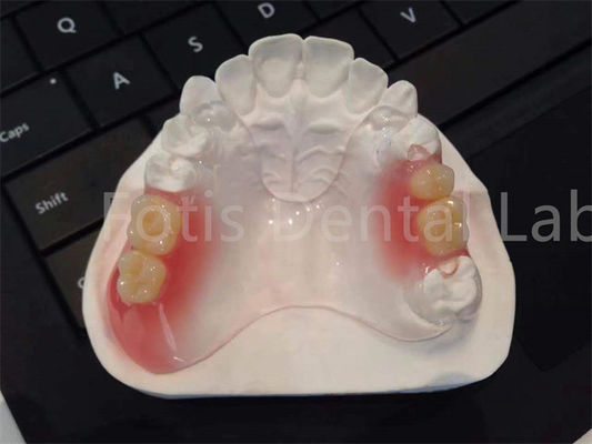 Flexible TCS Valplast tandheelkundige apparaten Comfortabel Duurzaam ontwerp