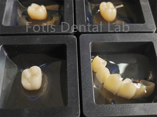 Tandheelkundige herstelwerk Zirconia Meerlaagse breukbestendigheid
