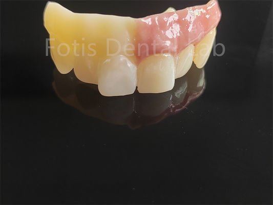 Monolithisch Zirconia met een laag porselein computerondersteund ontwerp