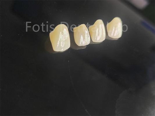 Professionele porselein gesmolten zirconia voor perfect passende tandherstelingen