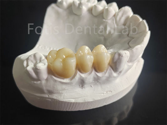 Versletenheidsbestendige Zirconia met een laag van porseleinen tandheelkundig materiaal