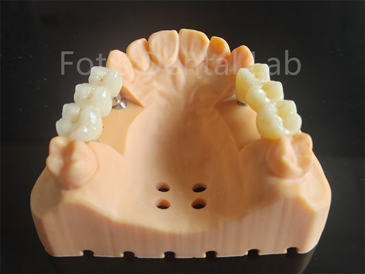 Gepersonaliseerd volledig gecontouriseerd zirconia met een laag porseleinen tandheelkundig materiaal