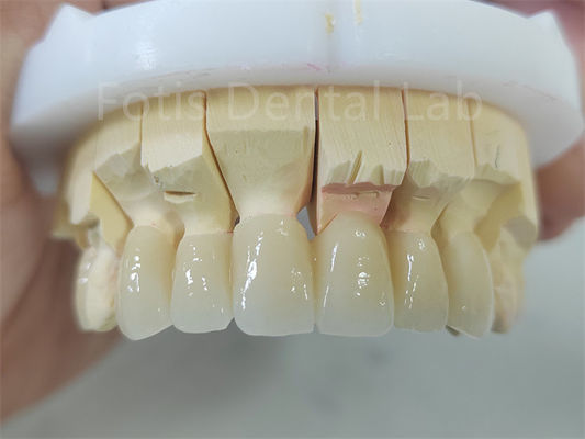Tandheelkundig product Zirconia met porseleinenlaag Gemakkelijk onderhoud