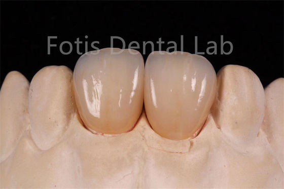 Hoge doorschijnendheid meerlagig zirconia voor de vervaardiging van tandheelkundige restoratie